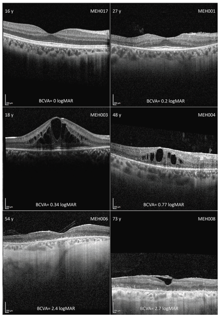 A first in-depth retrospective longitudinal study of Usher syndrome on ...